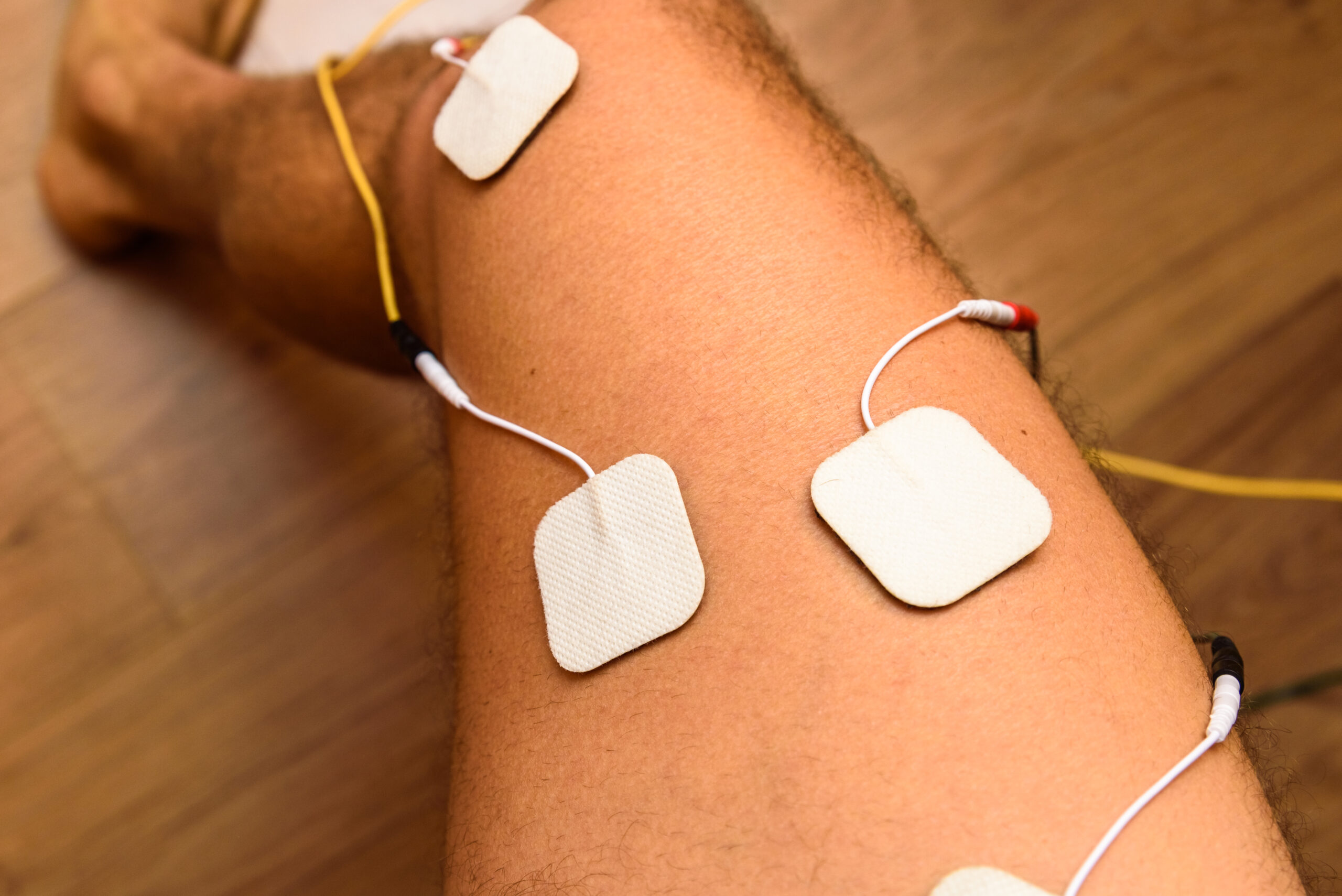TENS (Transcutaneous Electrical Nerve Stimulation)