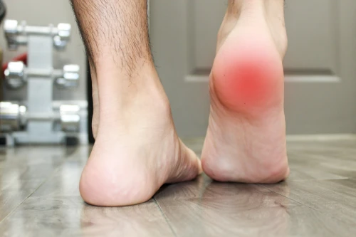 Two bare feet on a wooden floor, with the right heel showing a red irritated area, exercise equipment blurred in the background.